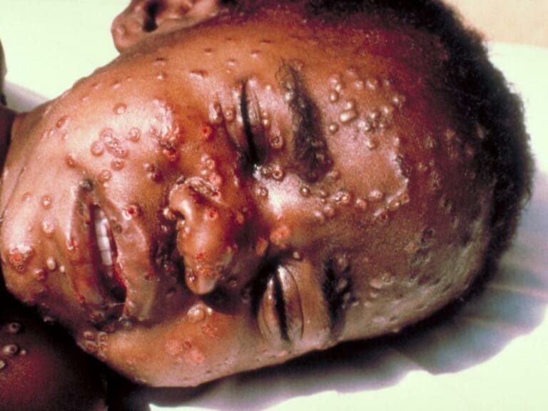 Großbritannien: Affen-Pocken aus Nigeria — Bild: Centers for Disease Control and Prevention s Public Health Image Library / Wikimedia (PD)